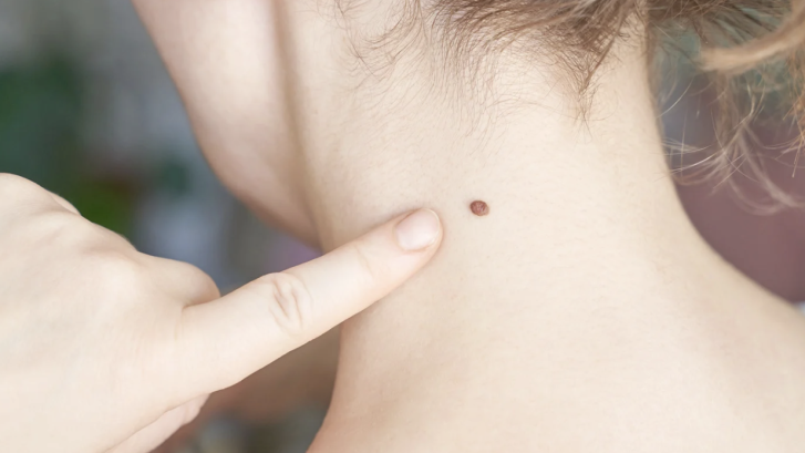 Where to Book Your Next Dermatology Appointment in Waldorf or Prince Frederick